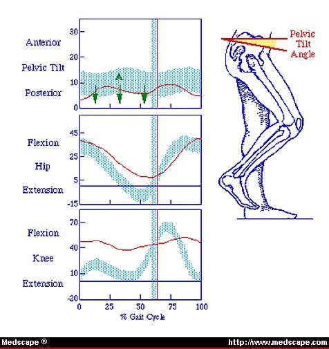 Posterior tilt of pelvis in stance (Point A) is consistent with hamstring 