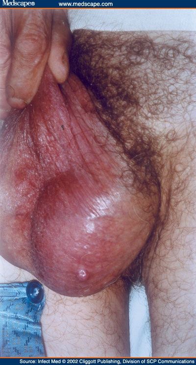 Epididymitis Orchitis