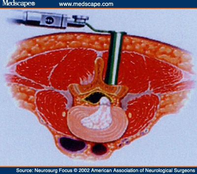 microlumbar discectomy