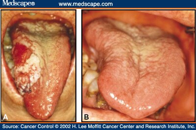 Oral Cancer Tongue