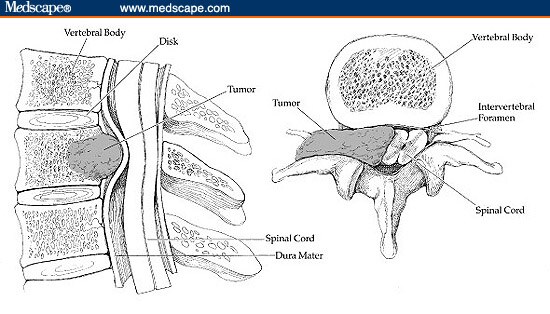 Spinal Cord Compression; Conus Medullaris Syndrome; Myelopathy, Compressive