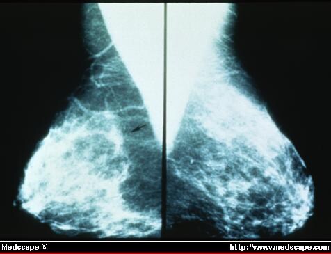 mammogram images of breast cancer. Force on Breast Cancer.
