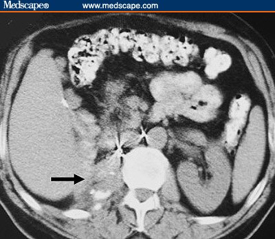 Paraspinal Region