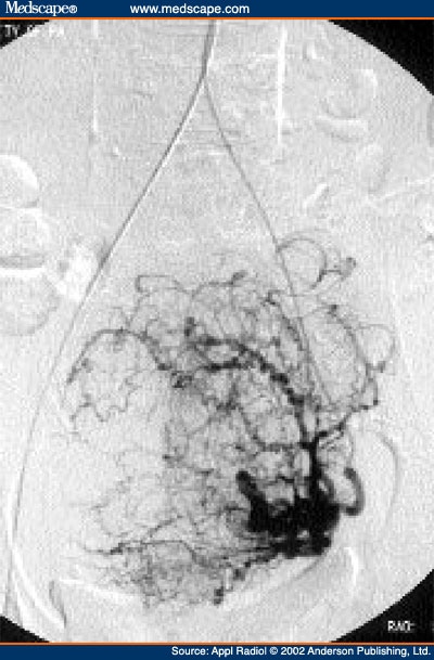 Uterine Fibroid Embolization: Procedure--Technical Aspects 