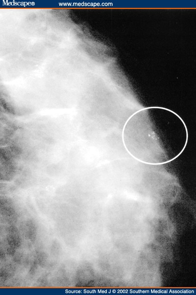 mammogram images of breast cancer. Mammogram of left reast shows