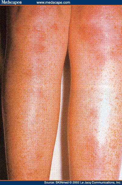 heat rash pictures in adults. heat rashes in adults. page