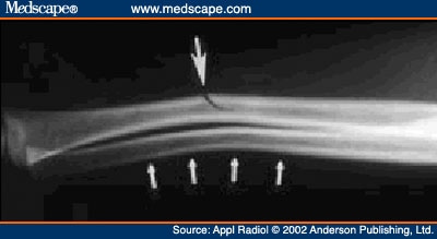 Plastic+bowing+fracture