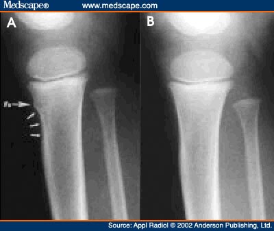 Subtle Fractures in Kids: How Not to Miss Them