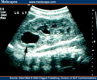  age shows a left duplex collecting system with severe distention of the 