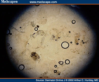 scabies on hands. Atypical Crusted Scabies in an