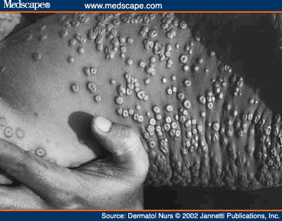 Smallpox Lesions on Skin of Trunk. Photo courtesy of CDC