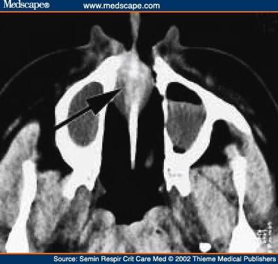 Sarcoid Ct