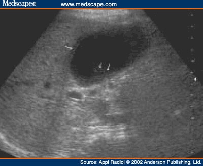 distended gallbladder