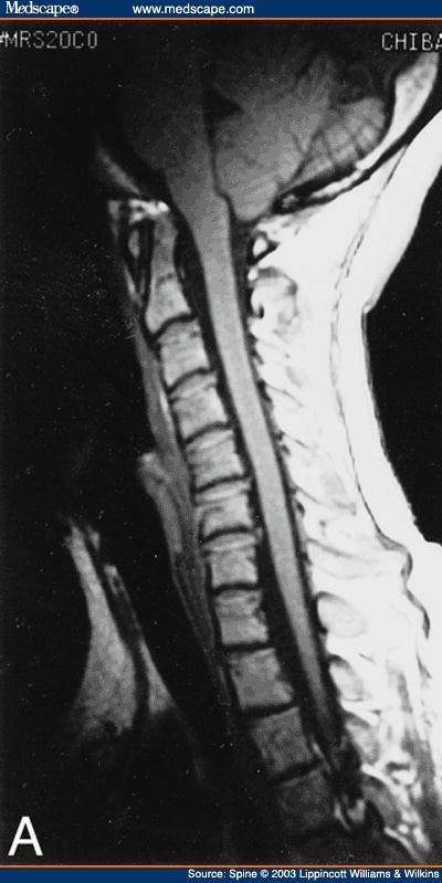 A girl had mild form of Chiari 1 malformation with a cerebellar tonsil 