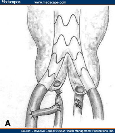 Abdominal-Aorta-Bypass ... Artery Occlusion in Endovascular Repair of Abdominal Aortic Aneurysms