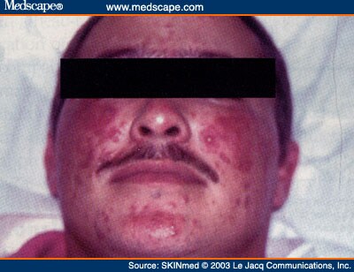 Erythema Rosacea