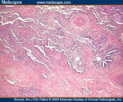 honeycomb appearance lung