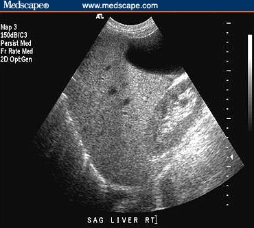 fatty liver disease. A sonogram of a fatty liver