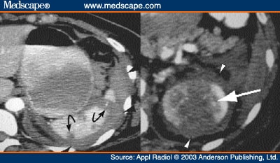 Effigy Arrow Heads on Triple Contrast Helical Ct Imaging  Wound Tracts And Peritoneal