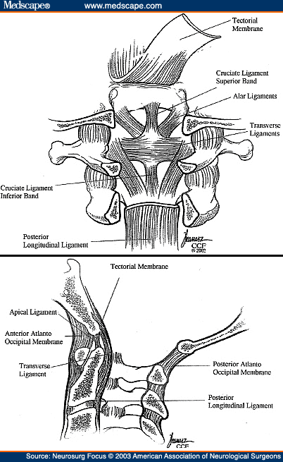 atlanto occipital fusion