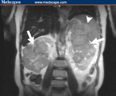 Renal Masses