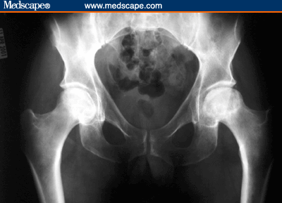 Steroid induced osteonecrosis hip