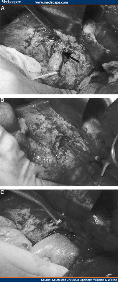 common bile duct obstruction. B, hilar iliary duct