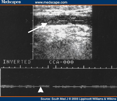 Duplex Doppler Ultrasound