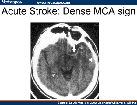 hemorrhagic stroke unequal pupils