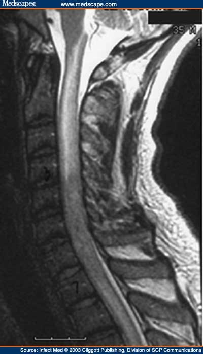 Leukemia Spine Mri