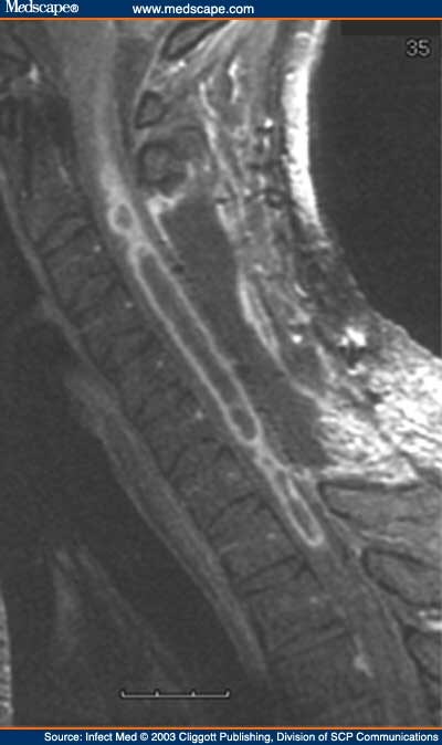 Leukemia Spine Mri