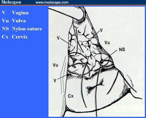 Obstetric Fistula