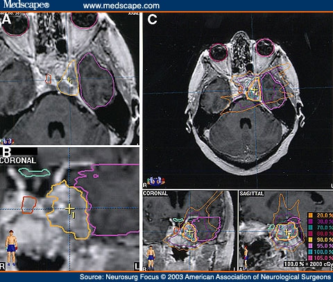  graft (interposed between pituitary gland and cavernous sinus tumor).