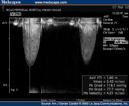 lvot gradient