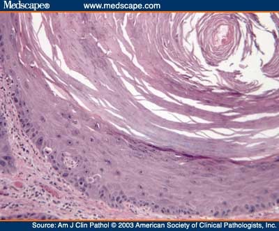 Epidermal inclusion cyst-like areas. This nest was located in the deep 