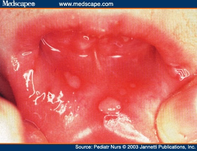 Primary Oral Herpes