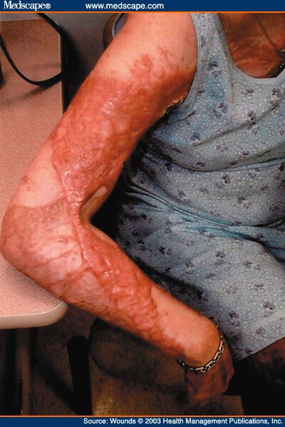 Oral Doxepin For Itching