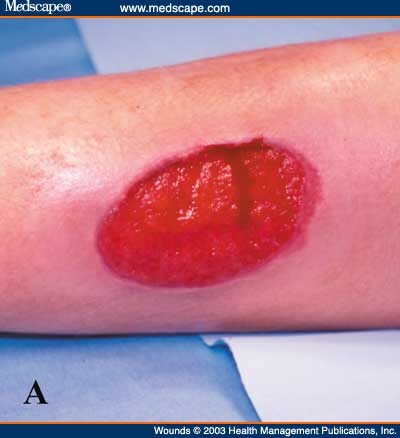 Molluscoid Pseudotumors