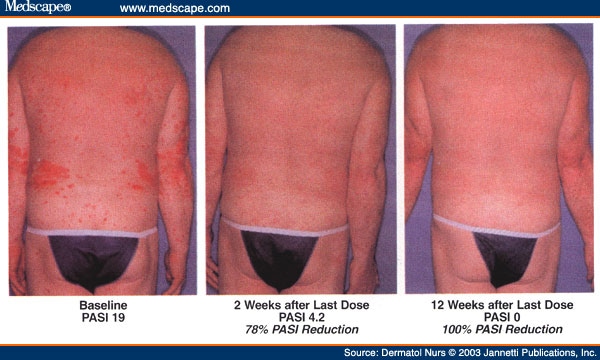 psoriasis area severity index