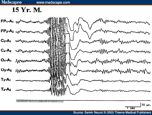 abnormal eeg normal vs epilepsy