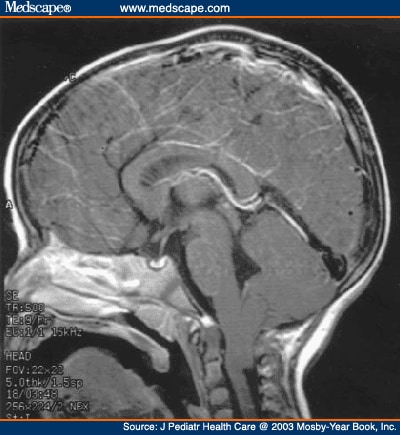  magnetic resonance image demonstrating Arnold-Chiari malformation type I 