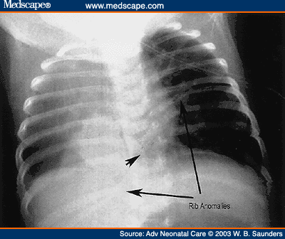 Congenital Rib Anomalies