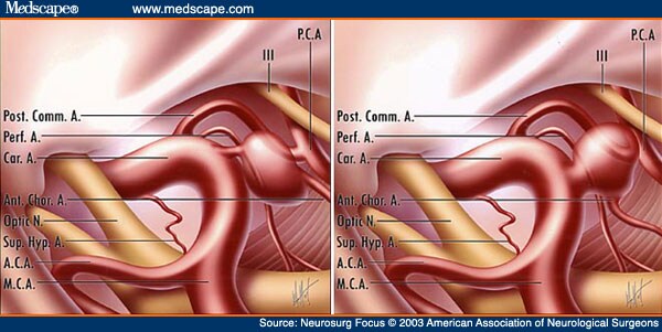 aneurysm clips. the aneurysm originates
