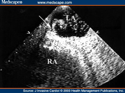 large patent foramen ovale