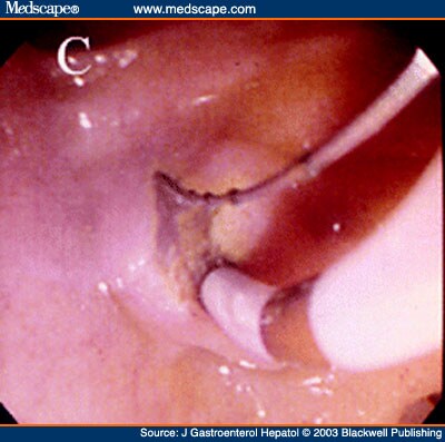 Biliary Sphincterotomy