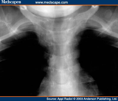 Congenital Cervical Lung Herniation: Discussion