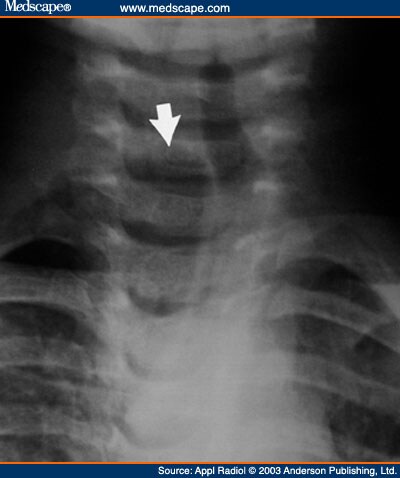 Congenital Cervical Lung Herniation: Discussion