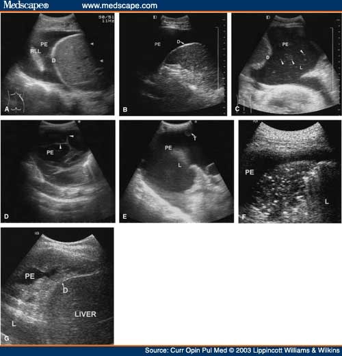 Ultrasound In The Diagnosis And Management Of Pleural Disease