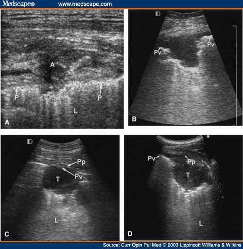 (A) Ultrasound (US) shows a chest wall abscess in a patient with liver 