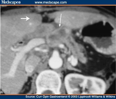 Ductal Dependent Lesions